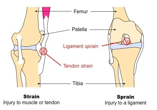 Sports injury conditions Sprains & Strains – The Body Rehab