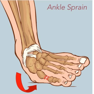 sprain ankle