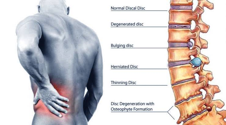 lumbar-disc-herniation-lower-back-pain-cambofitness