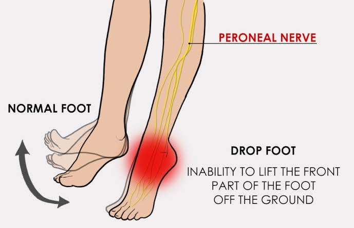 Neurological Conditions Foot Drop The Body Rehab 6856