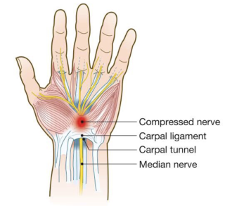 Neurological conditions Carpal Tunnel Syndrome – The Body Rehab