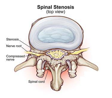 Conditions Sciatica – The Body Rehab