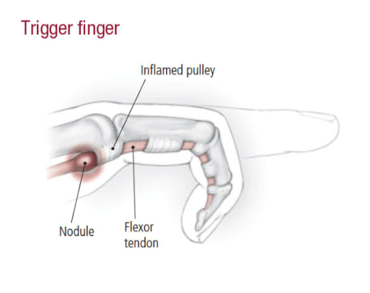 conditions-trigger-finger-the-body-rehab