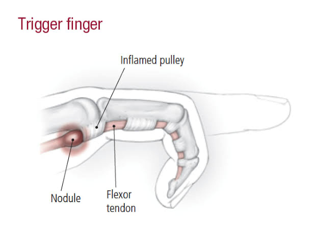 Conditions Trigger Finger – The Body Rehab